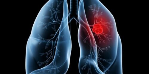 Saiba o que é adenocarcinoma pulmonar, câncer que atinge o Papa Leão XIV