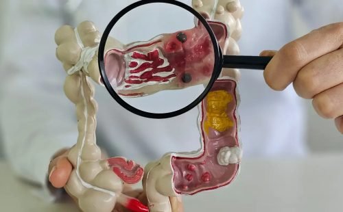 Em 13 anos, doença inflamatória intestinal cresce 5 vezes no Brasil