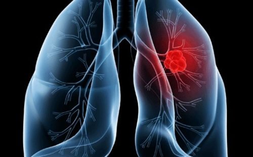 Saiba o que é adenocarcinoma pulmonar, câncer que atinge o Papa Leão XIV