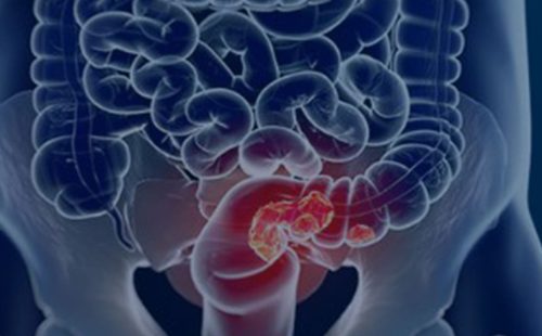 Rastreamento para câncer colorretal pode ser implementado no SUS