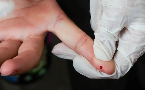 SUS passa a oferecer teste rápido de dengue