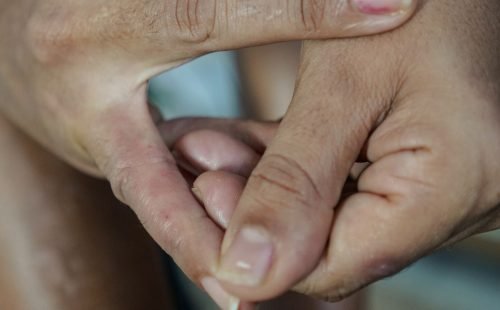 Dermatite atópica impacta pele, sono e autoestima: saiba como tratar